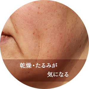 乾燥・たるみが気になる